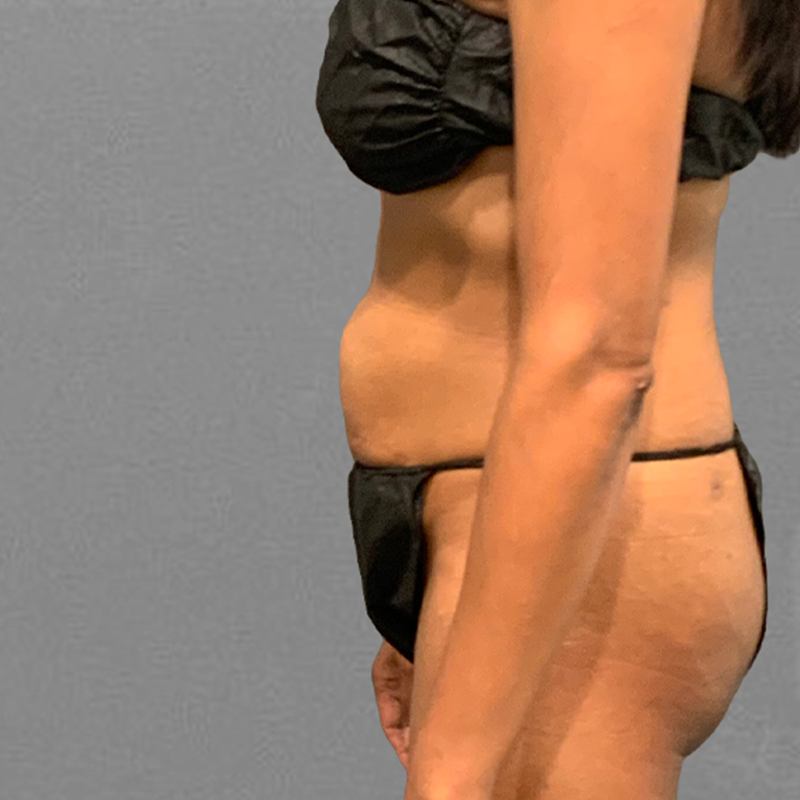 after pubic airsculpt 