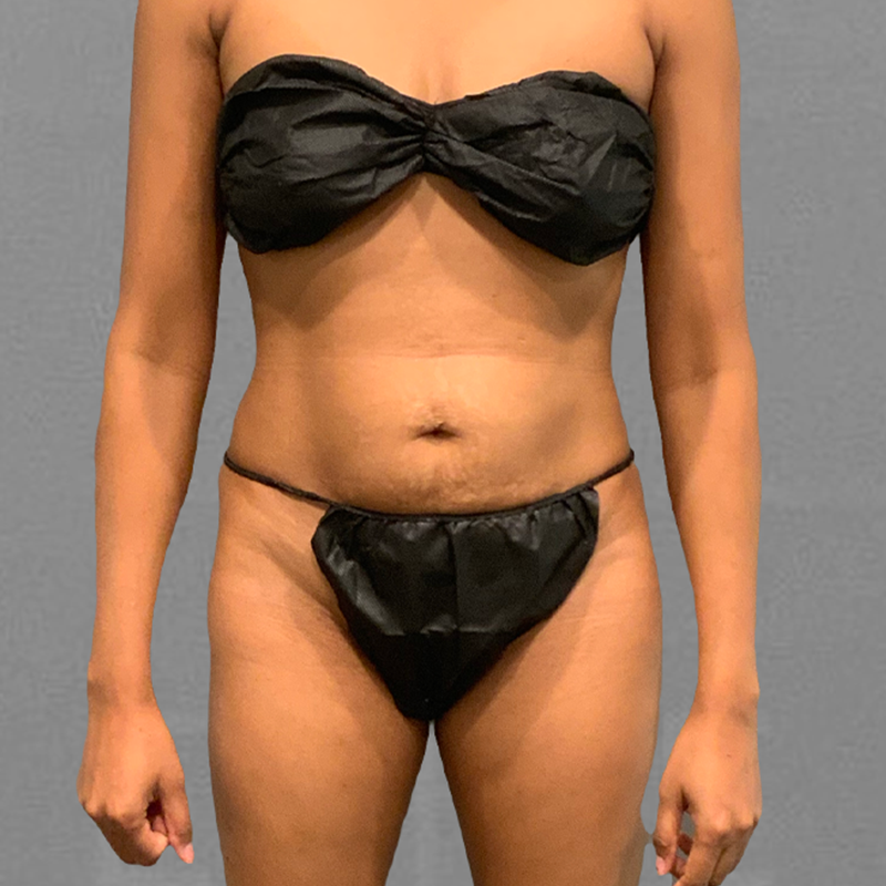 After lower stomach airsculpt