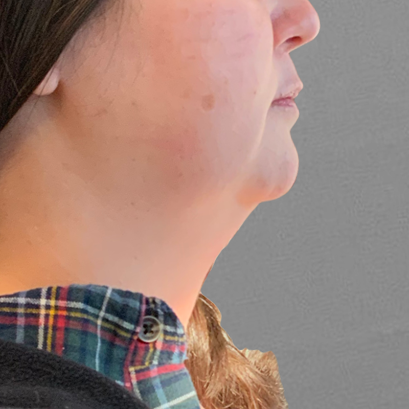 Before chin fat removal with airsculpt