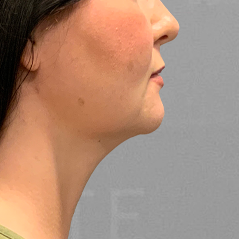 After chin fat removal with airsculpt