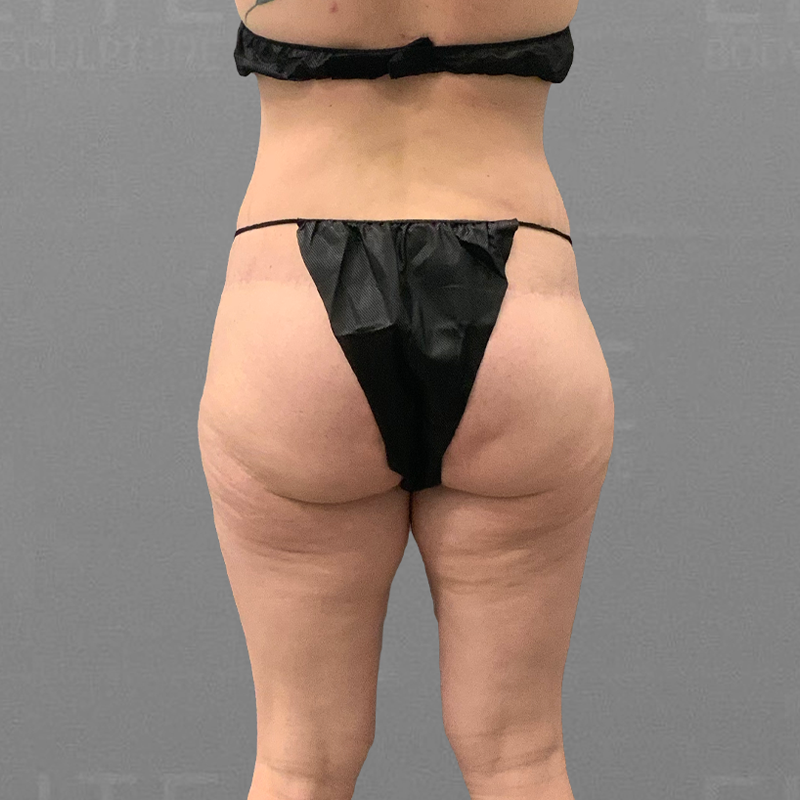 before airsculpt inner thigh liposuction