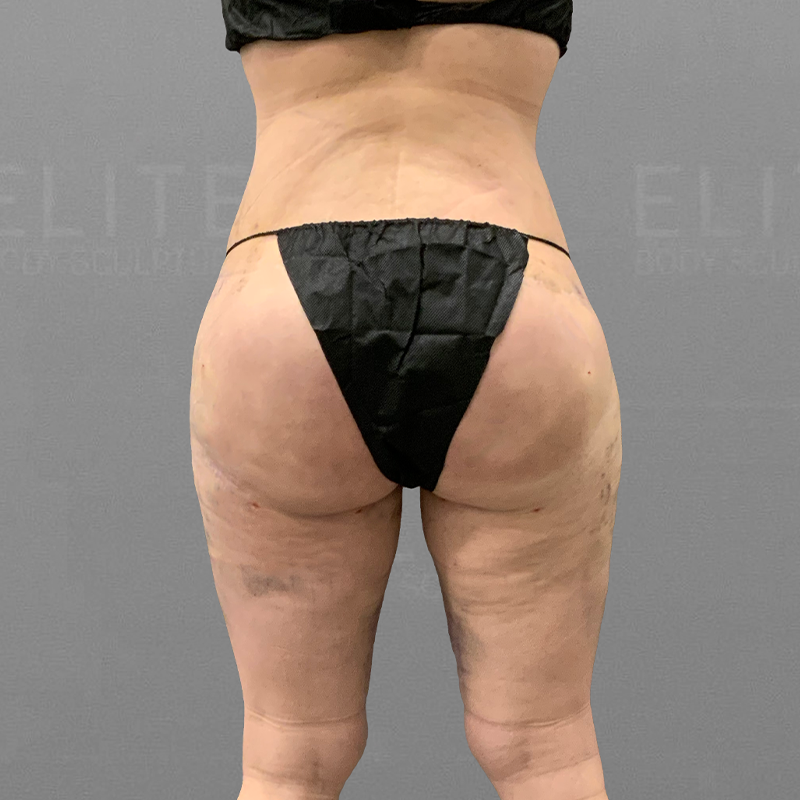 After inner thigh fat liposuction airsculpt