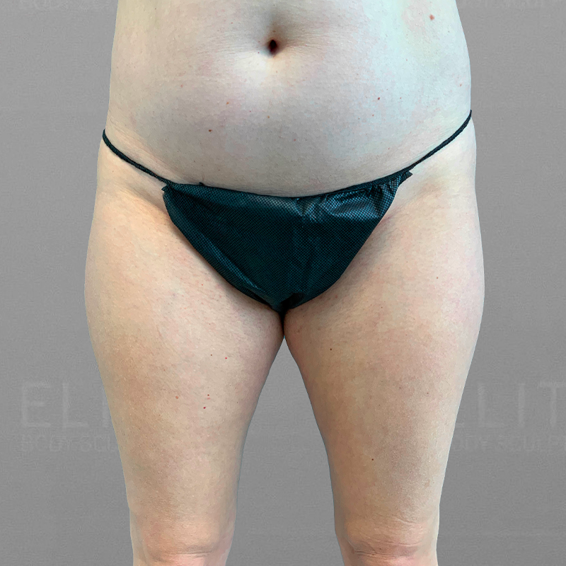 inner thigh airsculpt before-after