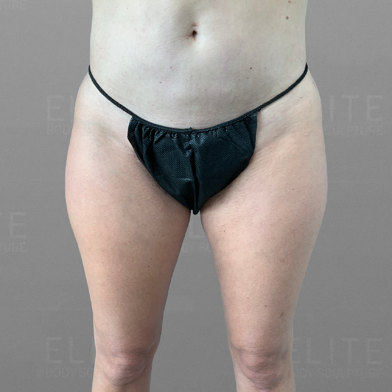 inner thigh airsculpt before/after