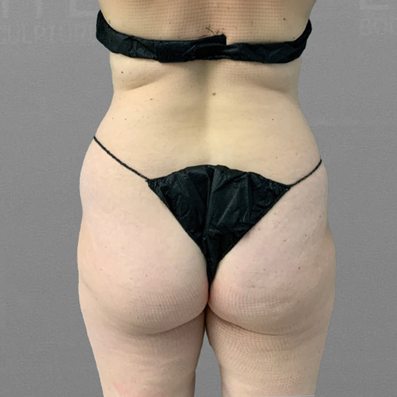before back airsculpt