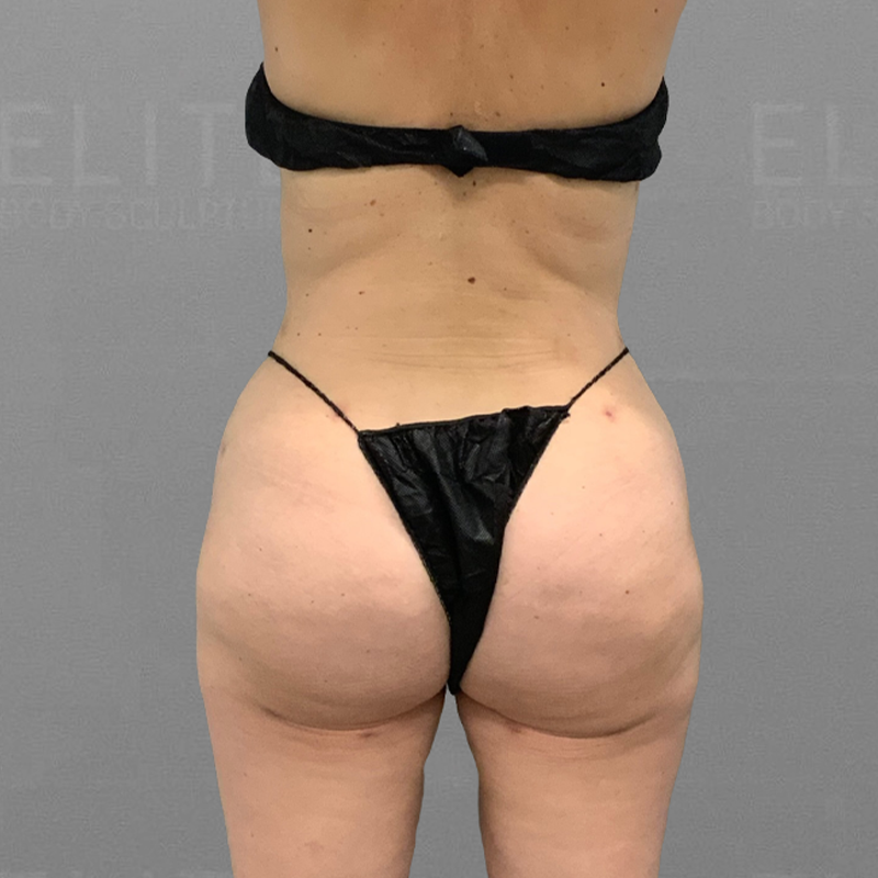 after back airsculpt