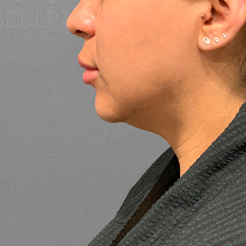 Chin AirSculpt before
