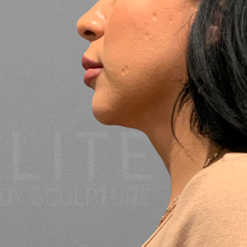 Chin AirSculpt after