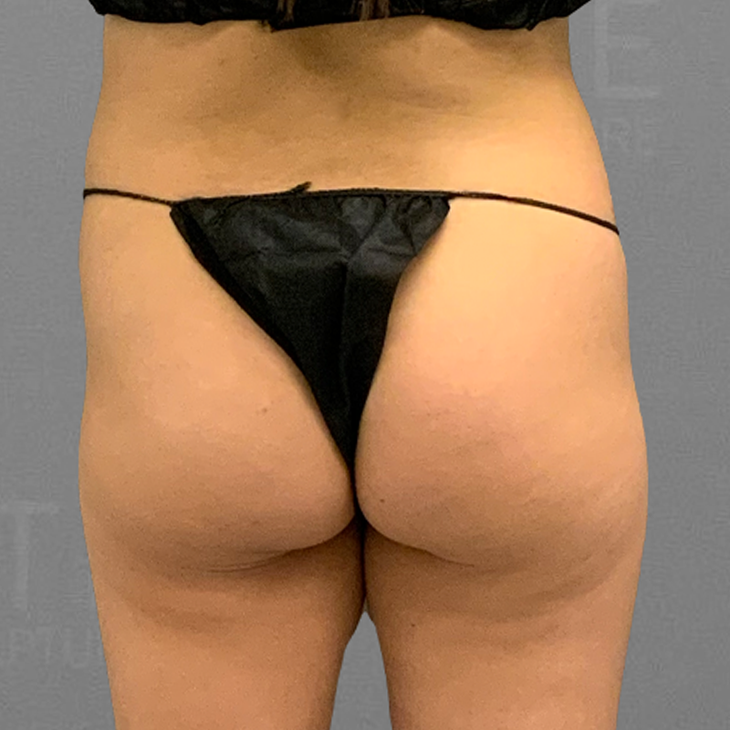 Before airsculpt bbl