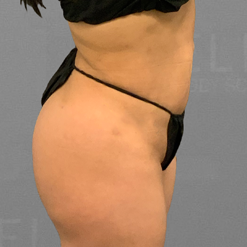 after pubic airsculpt