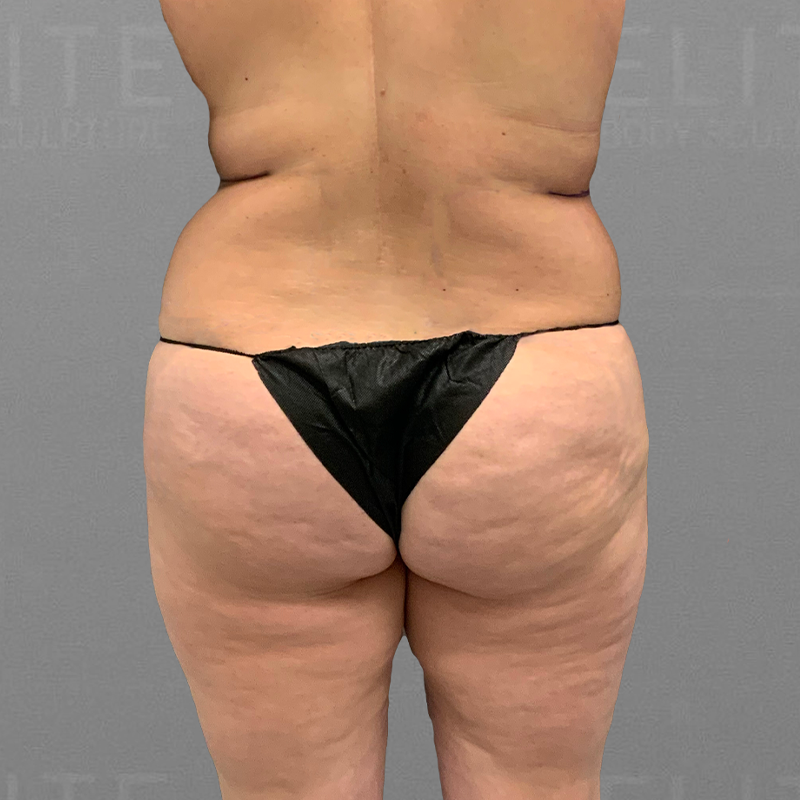 before back airsculpt