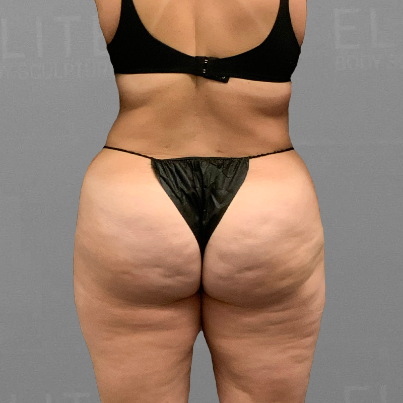 after back airsculpt