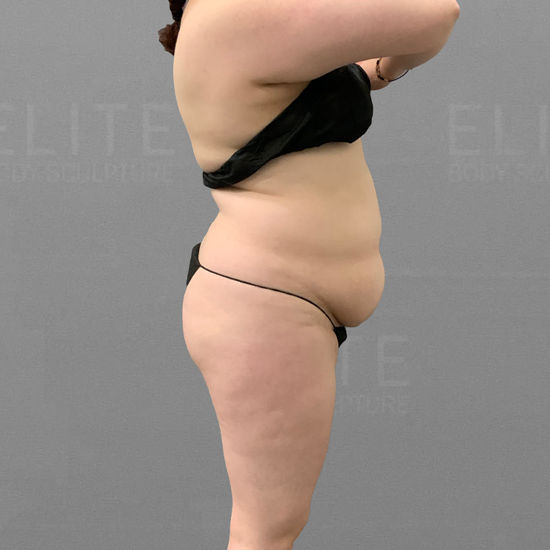 stomach fat removal airsculpt