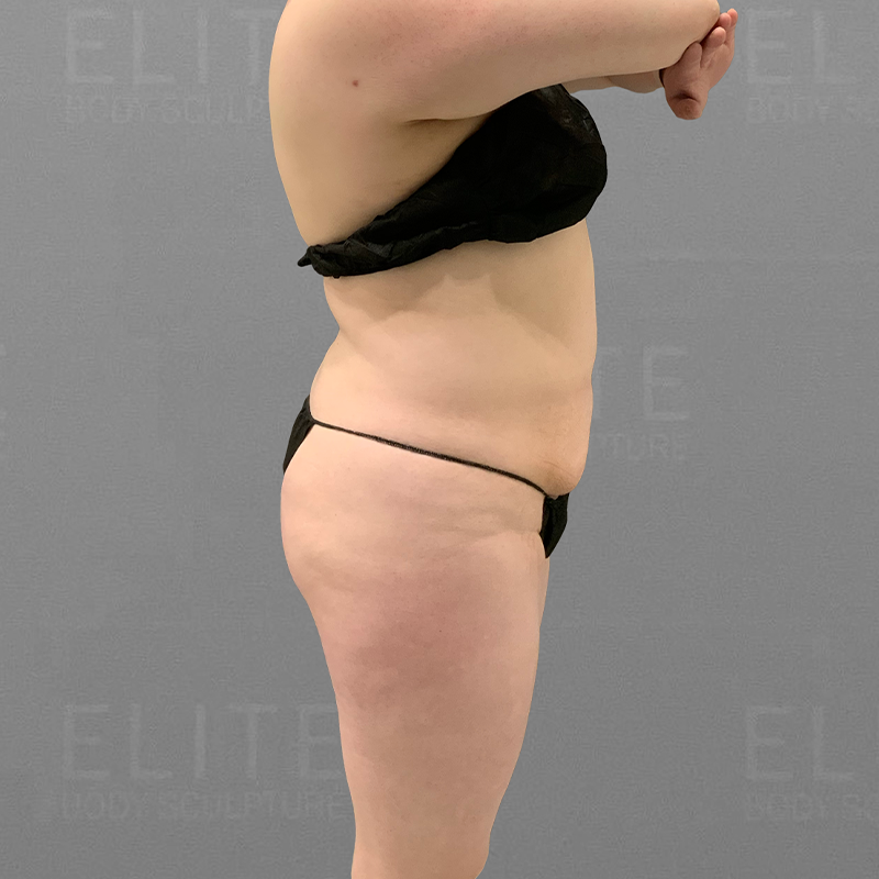 stomach fat removal airsculpt after