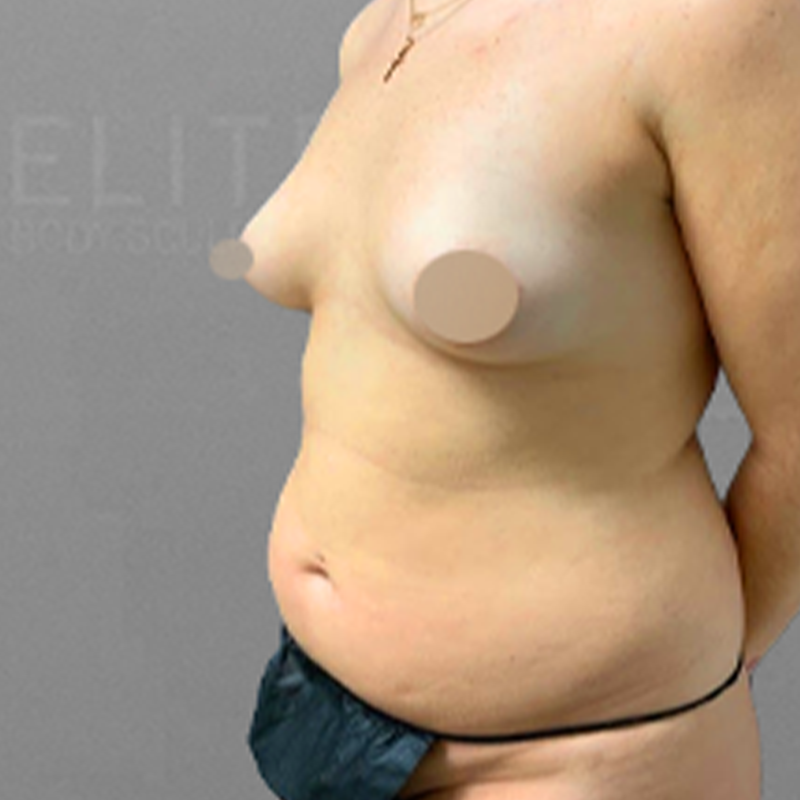 stomach airsculpt before