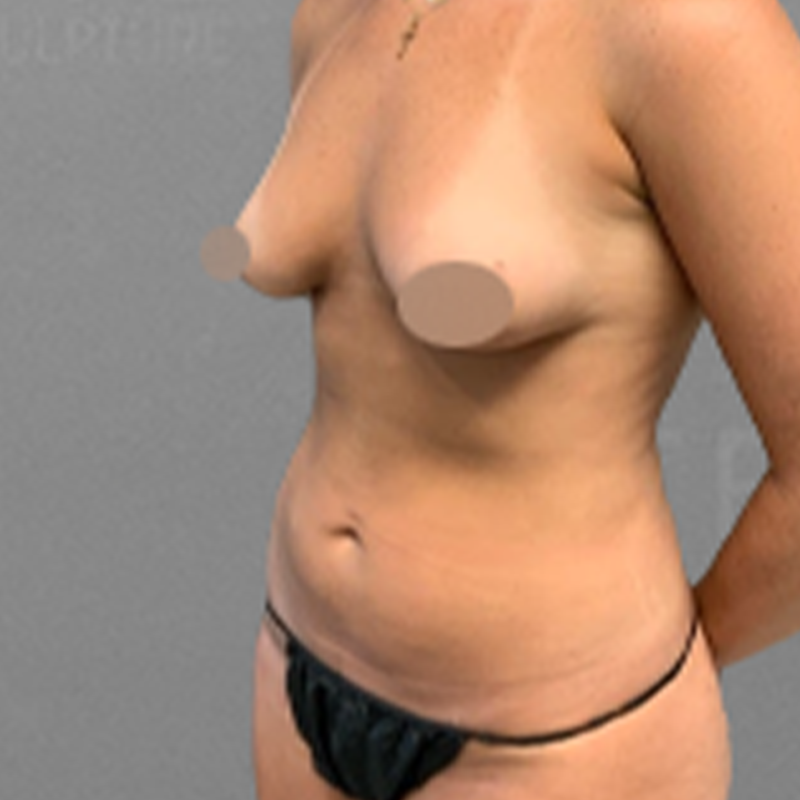 after stomach airsculpt
