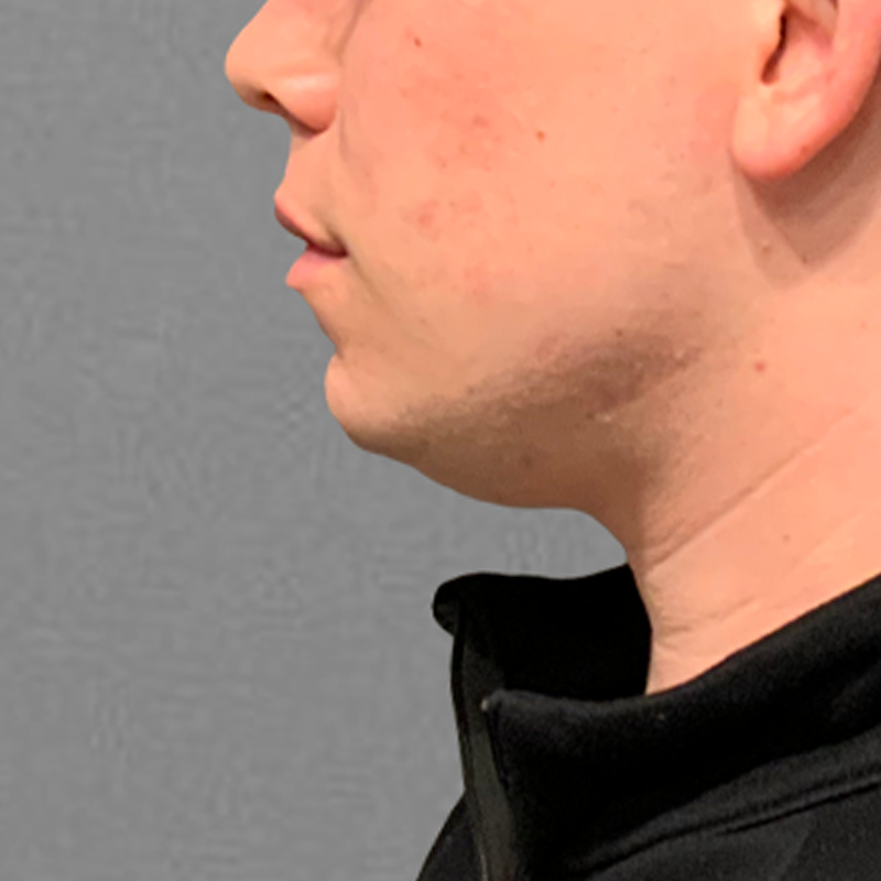 submental liposuction before