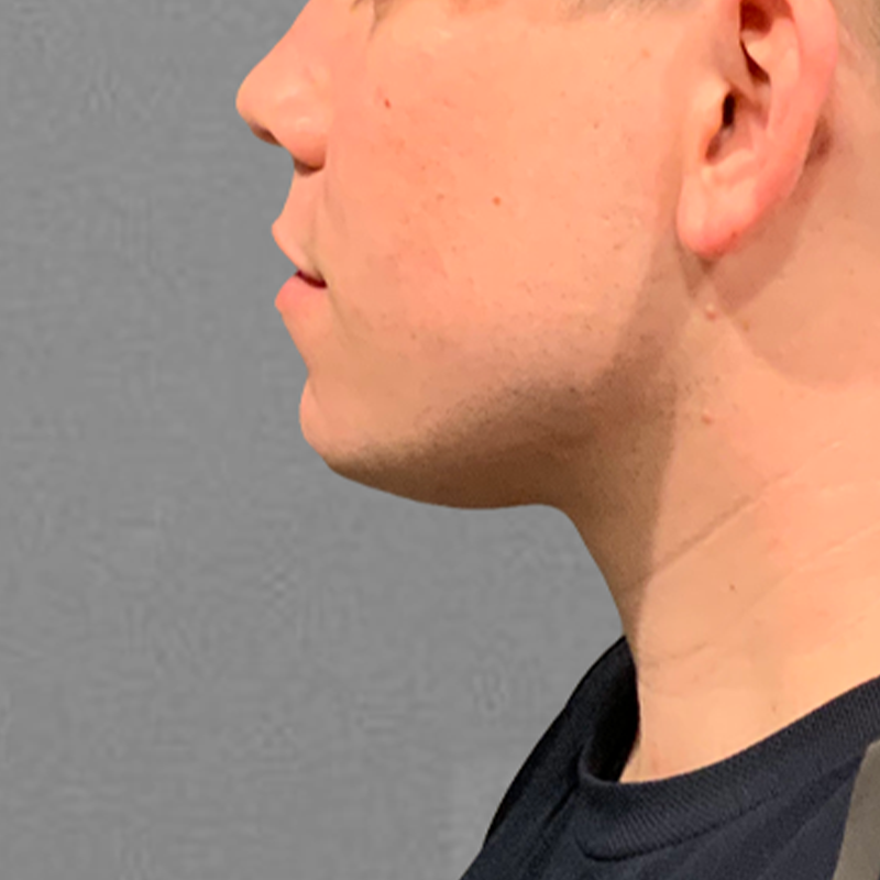 submental liposuction after