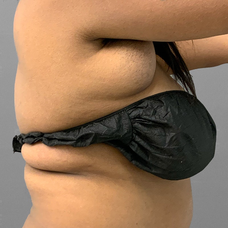 Before armpit liposuction