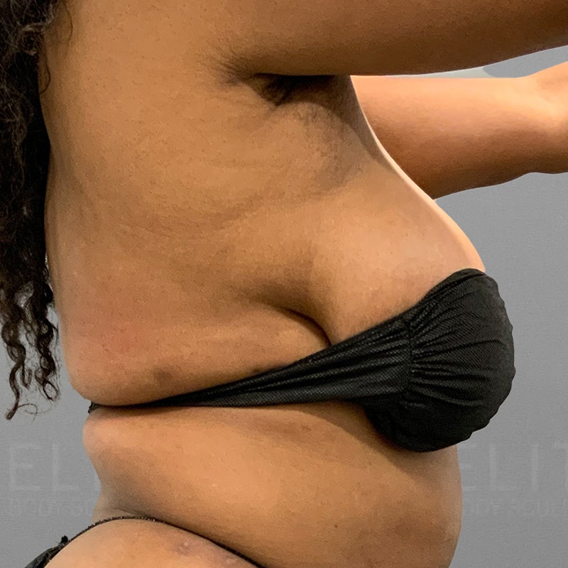 After armpit liposuction