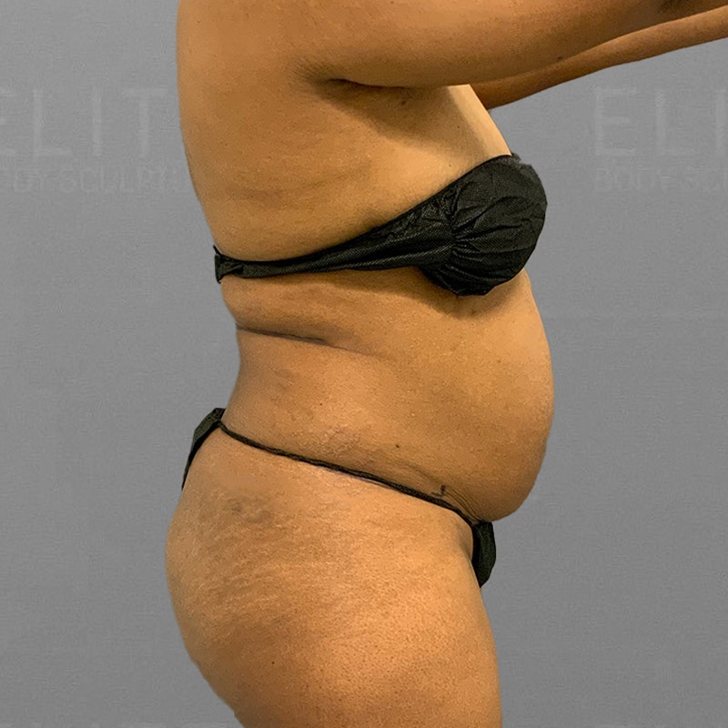 before back airsculpt lipo