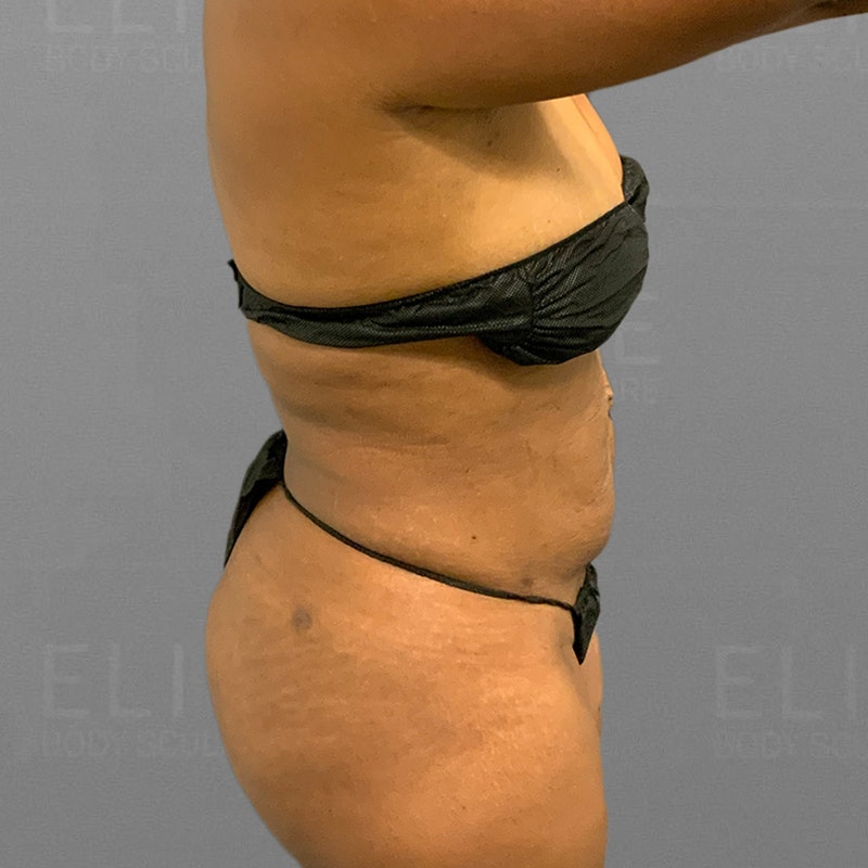 after back bra roll lipo