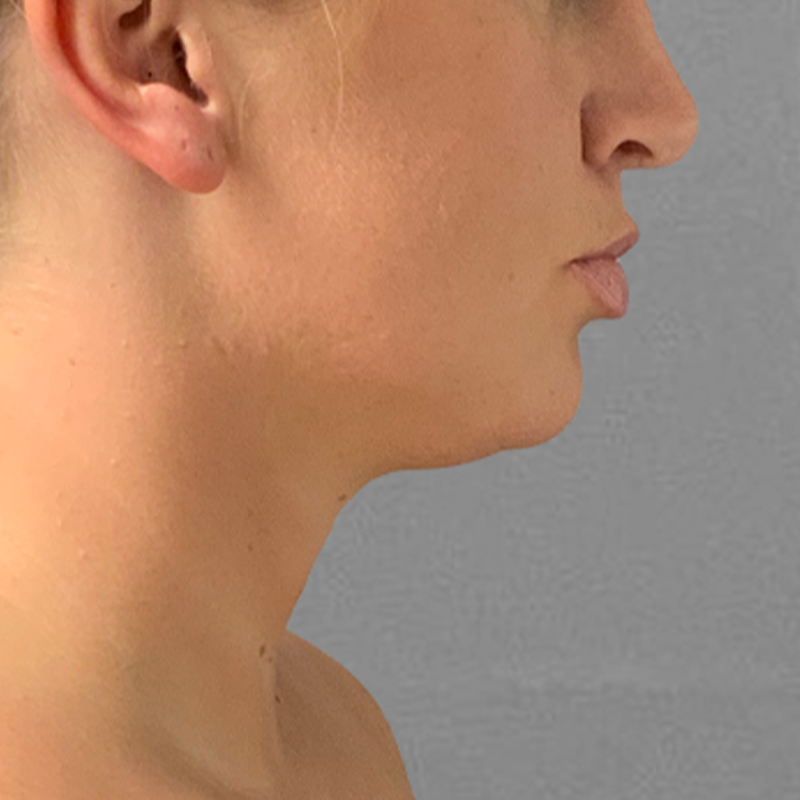 chin airsculpt pre-op