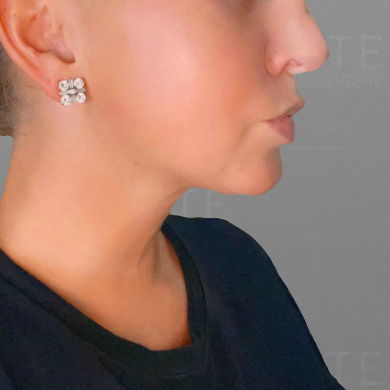 chin airsculpt