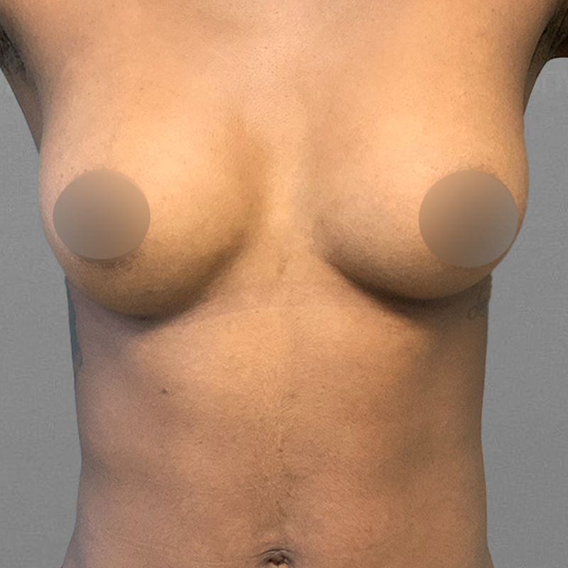 after airsculpt up a cup
