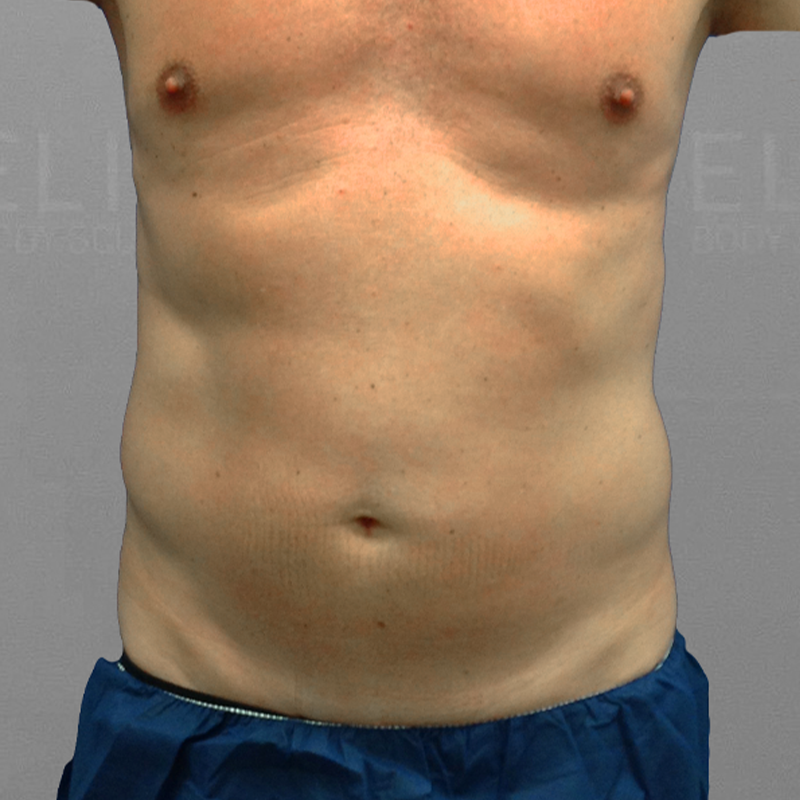 before airsculpt ab etching