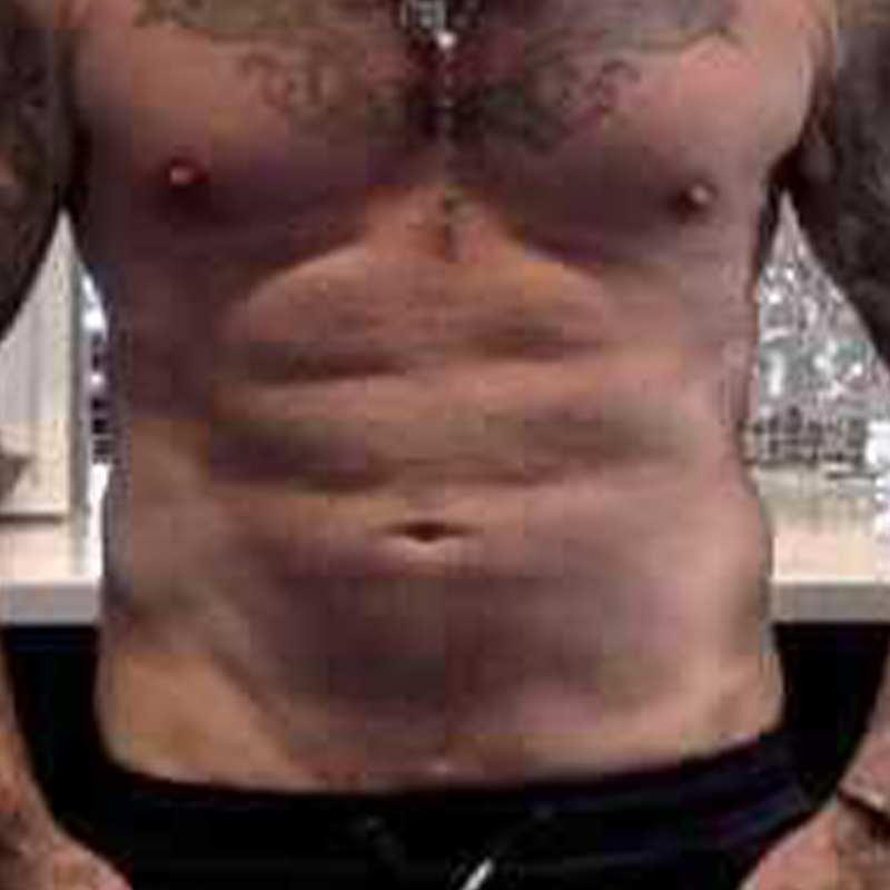 after airsculpt ab etching 