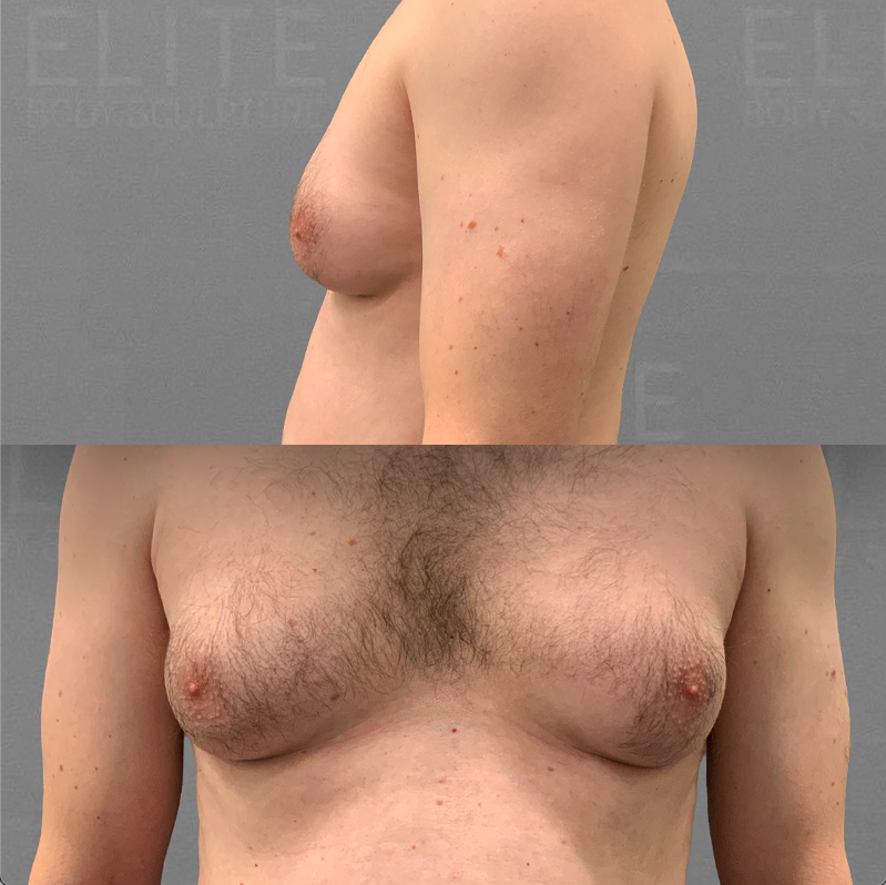 Gynecostmia Before