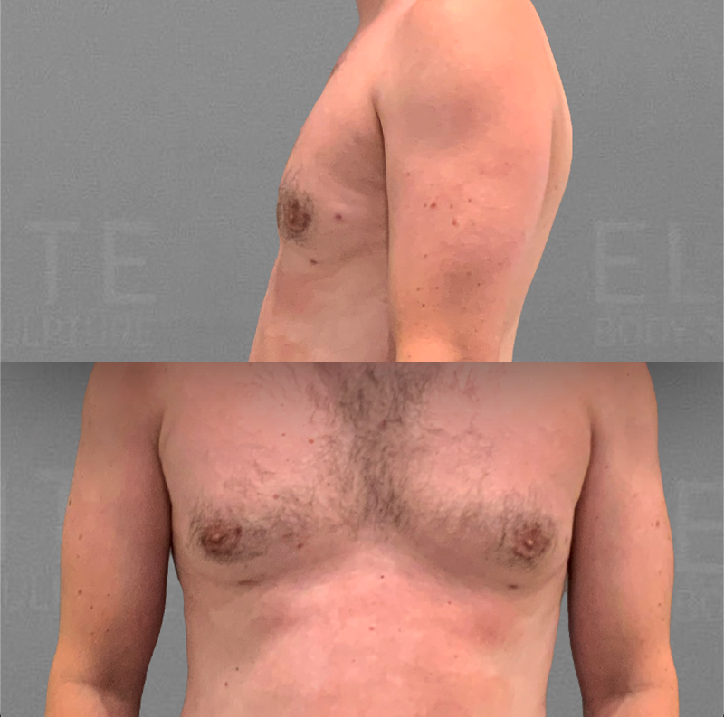 Gynecostmia After