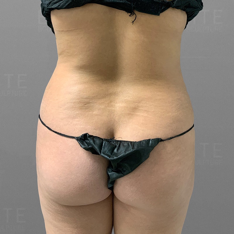 before airsculpt power bbl