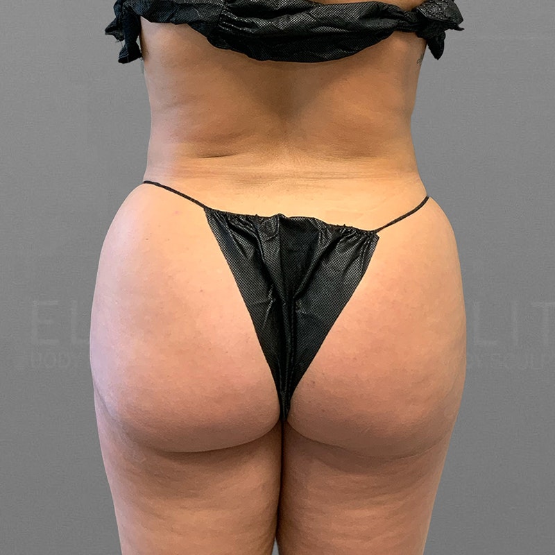 after airsculpt power bbl