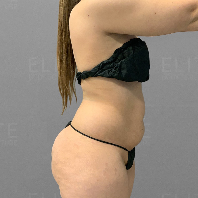 before stomach airsculpt