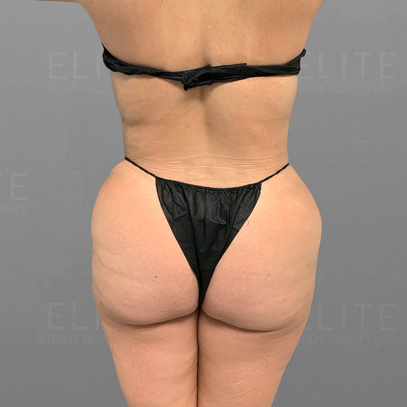After AirSculpt HipFlip