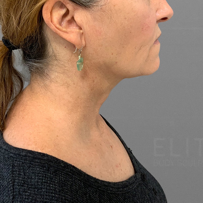 after submental airsculpt