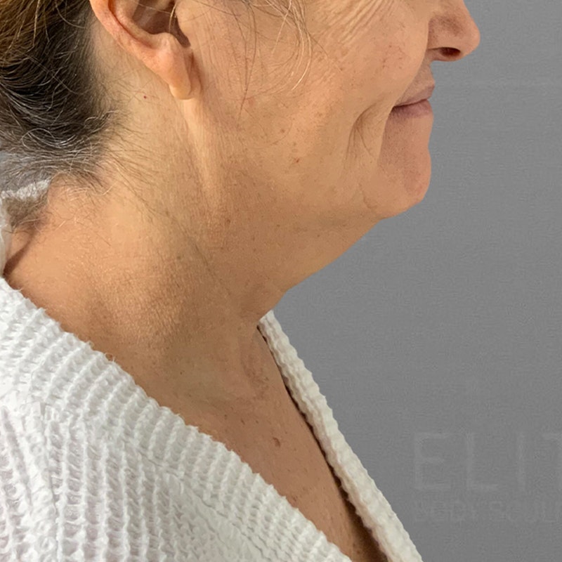 before submental airsculpt