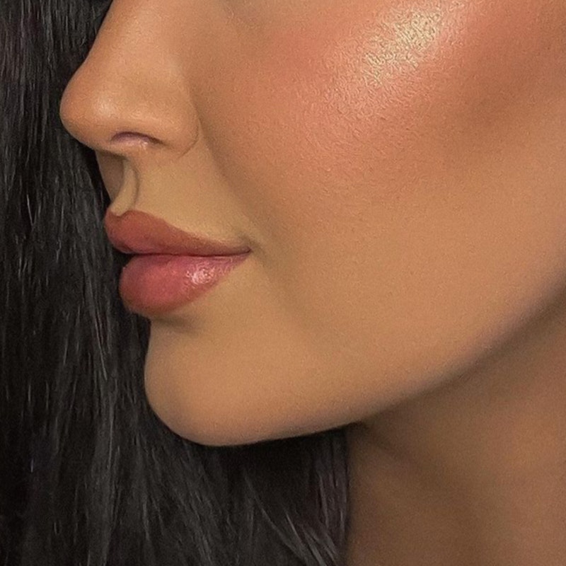 after chin lipo