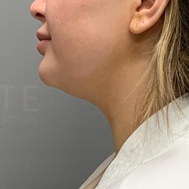 before chin lipo