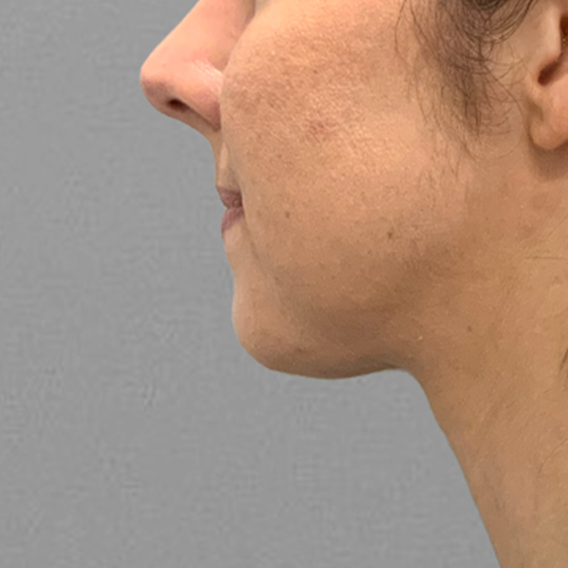 after chin airsculpt