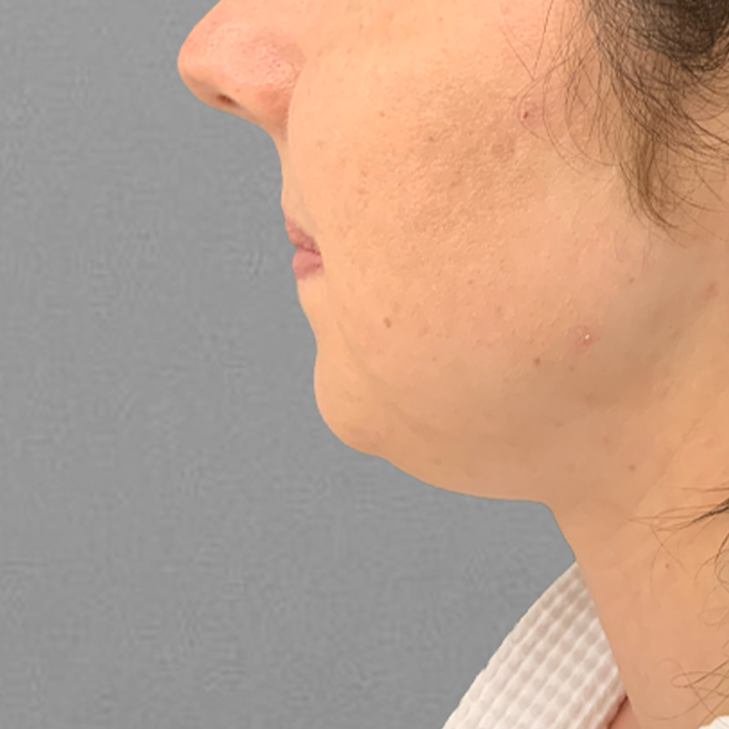 before chin airsculpt