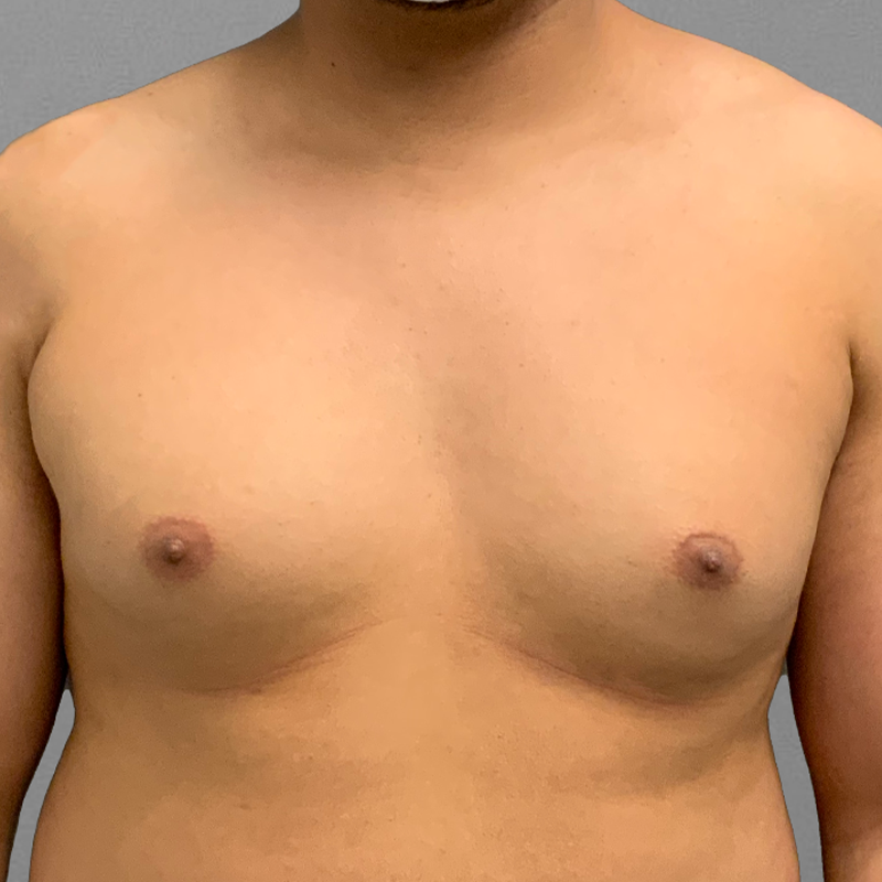 before male chest airsculpt