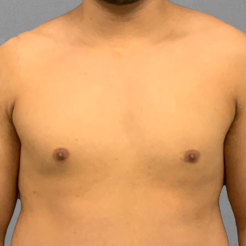after male chest airsculpt