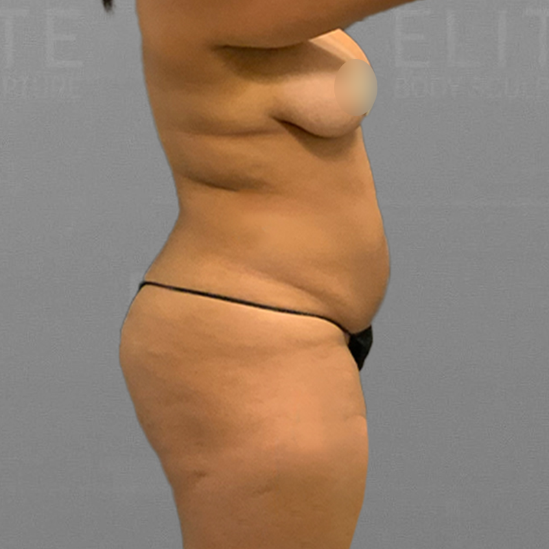 before full ab airsculpt