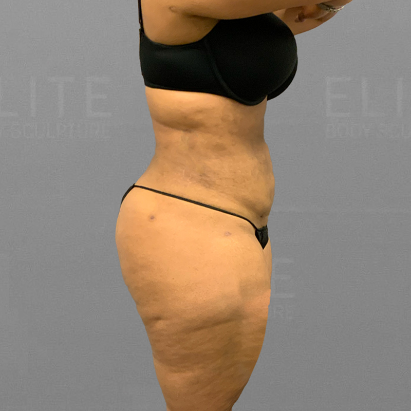 after full ab airsculpt