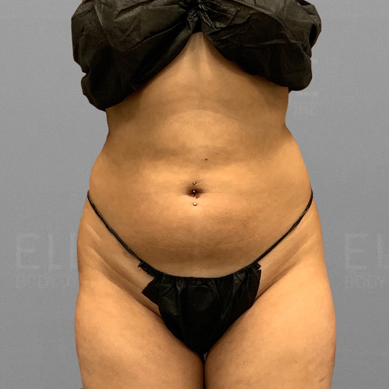 before full abdominal airsculpt