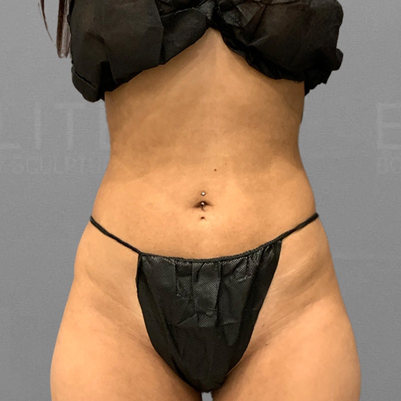 after full abdominal airsculpt