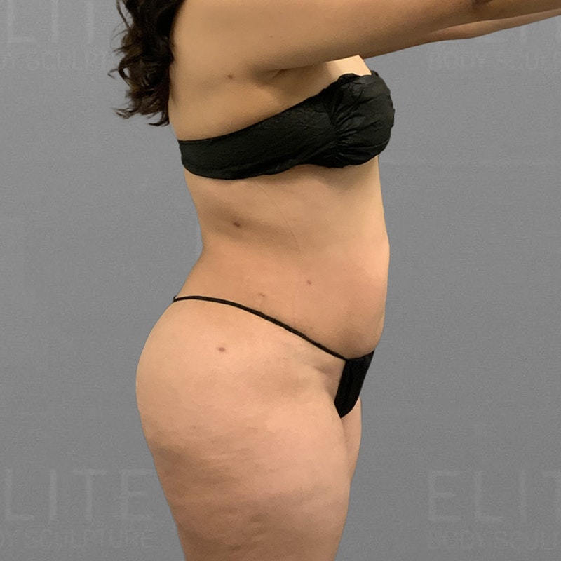 after full abdominal lipo